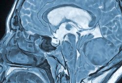 Hypnose bei Hirnoperationen: Ein sicherer Eingriff
