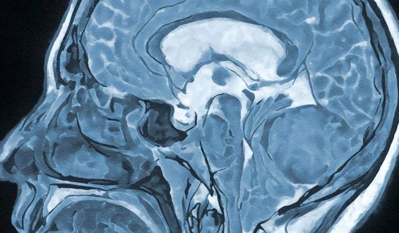 Hypnose bei Hirnoperationen: Ein sicherer Eingriff