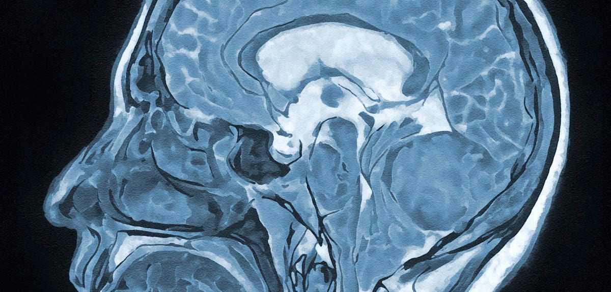 Hypnose bei Hirnoperationen: Ein sicherer Eingriff