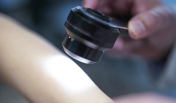 Studie zu Rückfällen: Hoffnung durch mRNA-Impfung gegen Hautkrebs