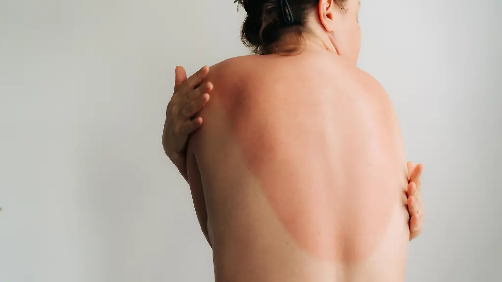 Krebsrisiko durch UV-Strahlung: Gefährliche Folgen von Sonnenbränden