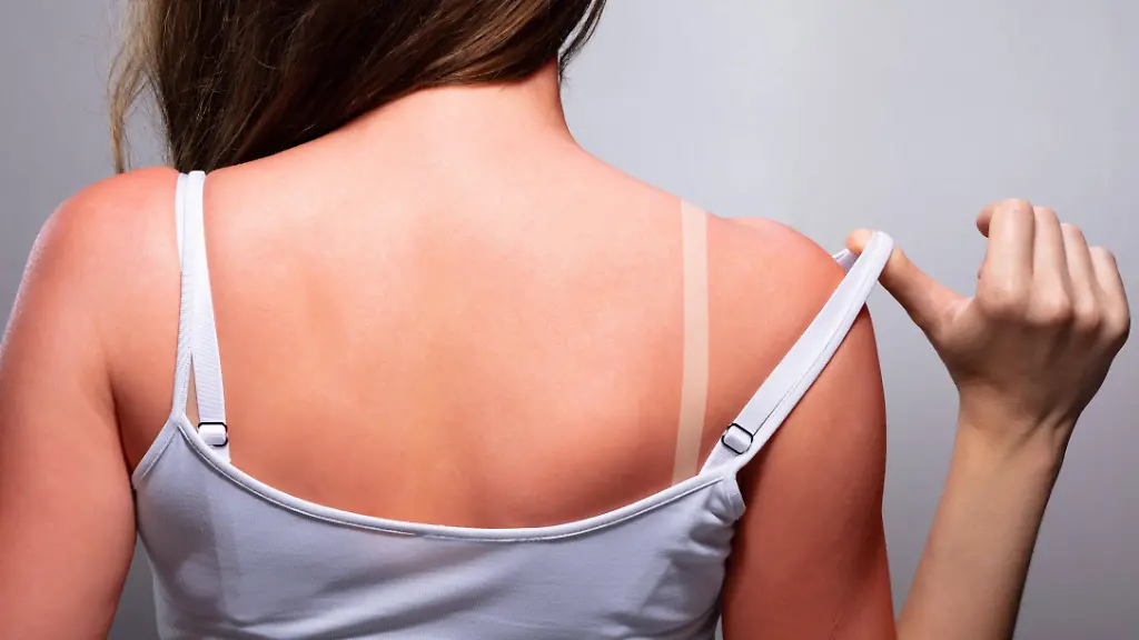 Tanmaxxing: Der gefährliche Trend zur Hautschädigung