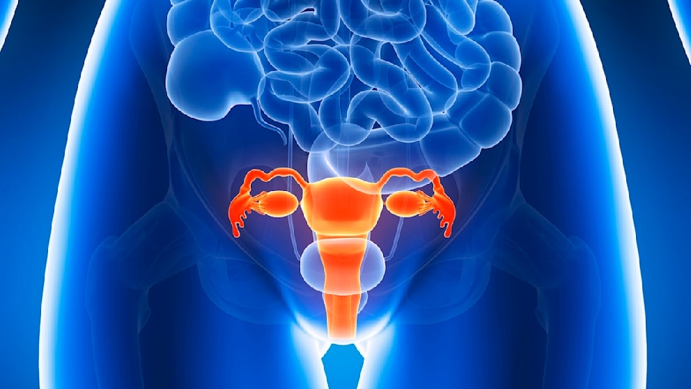 Endometriose: Eine häufig unerkannt bleibende Erkrankung
